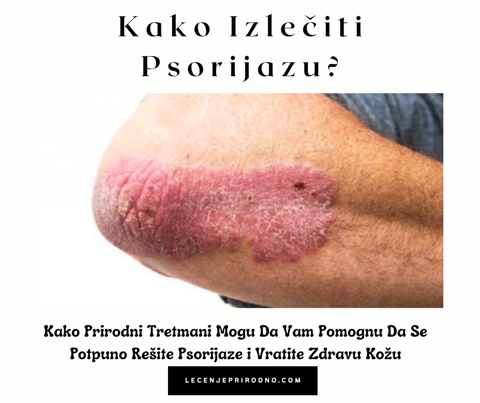 psorijaza lečenje