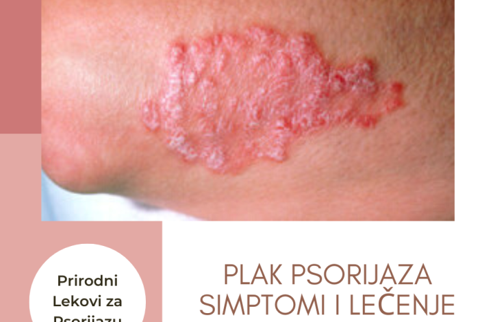 lecenje plak psorijaze prirodni putem