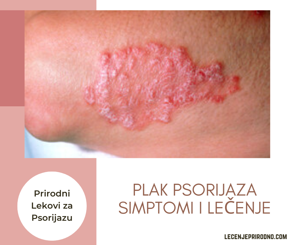 lecenje plak psorijaze prirodni putem