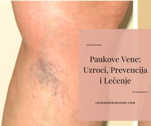 paučinaste vene uzroci i lecenje