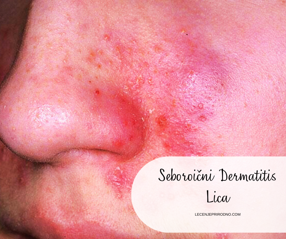 seboroicni dermatitis lica