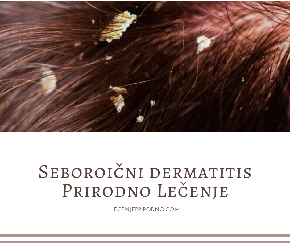 seboroicni dermatitis prirodno lecenje