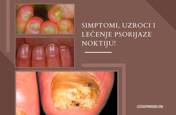 psorijaza na noktima