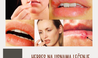 herpes na usnama lek