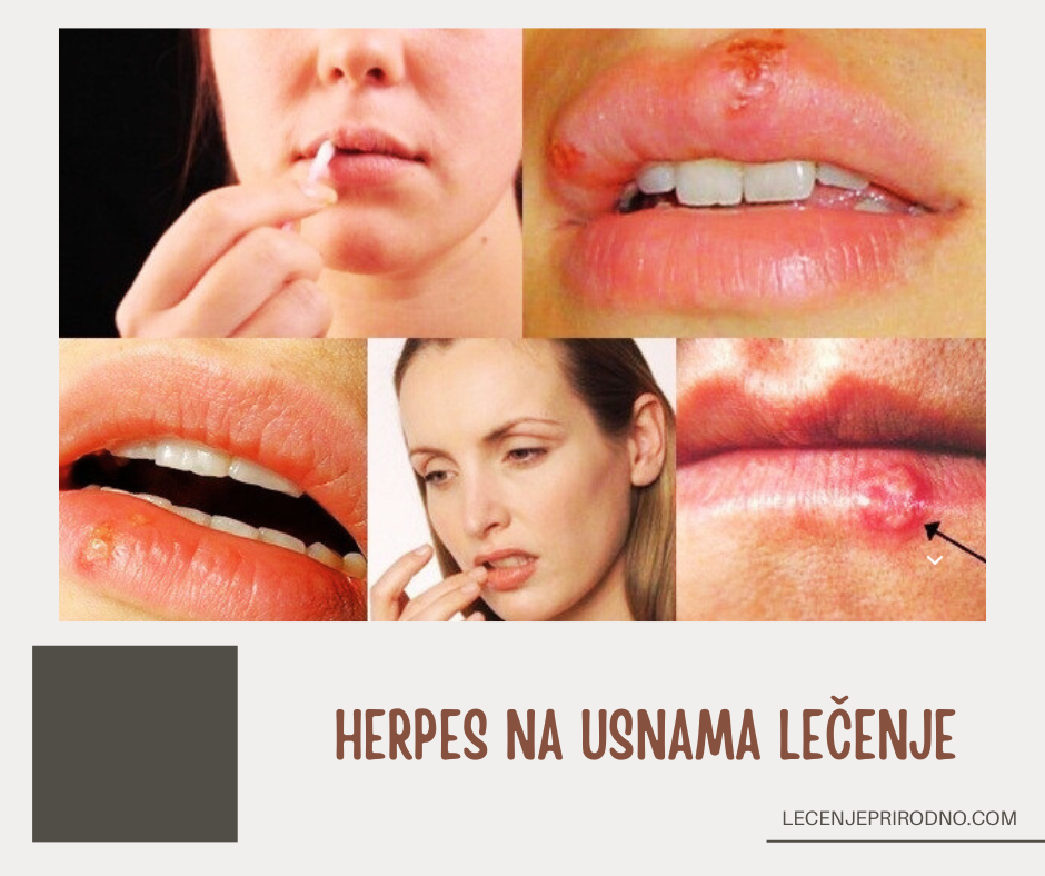 herpes na usnama lek