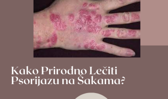 psorijaza na rukama lecenje prirodno