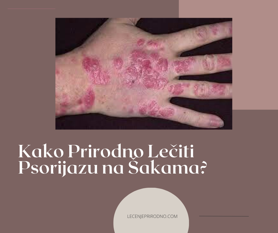 psorijaza na rukama lecenje prirodno