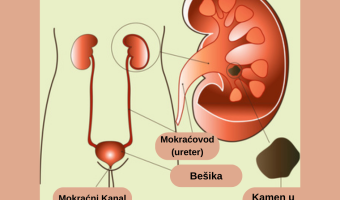 kamen u buregu lecenje