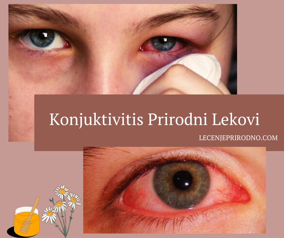 konjuktivitis prirodni lek