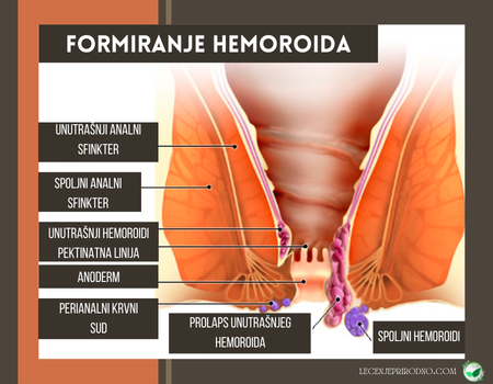 Formiranje hemoroida
